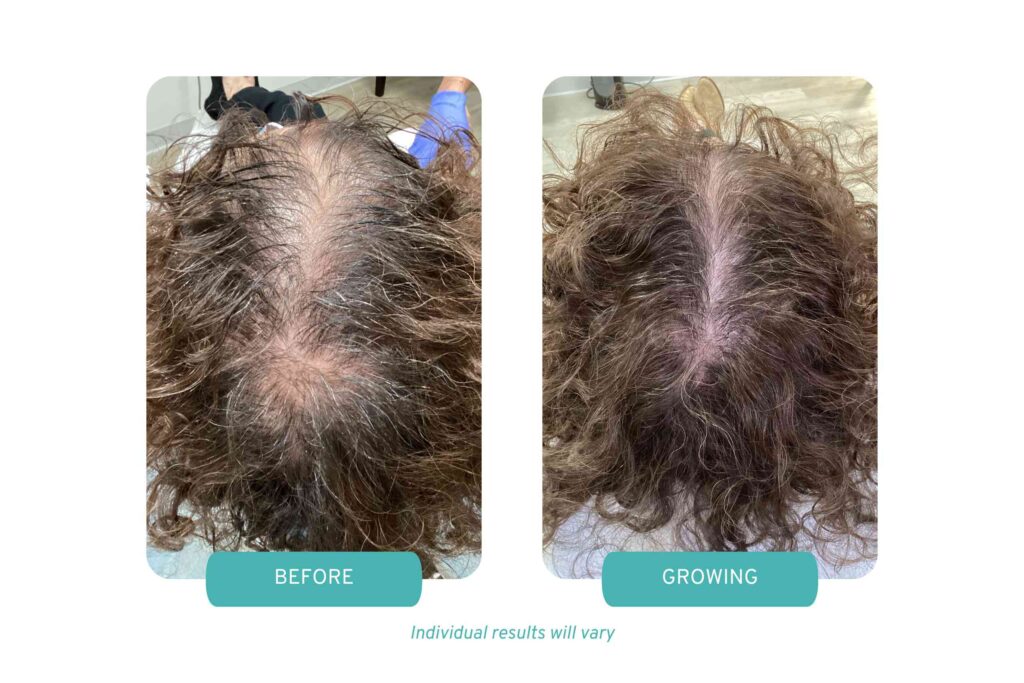 Combination therapy treatments for female hair loss in Westchester, NY Medi Tresse location. Before and growing concept.