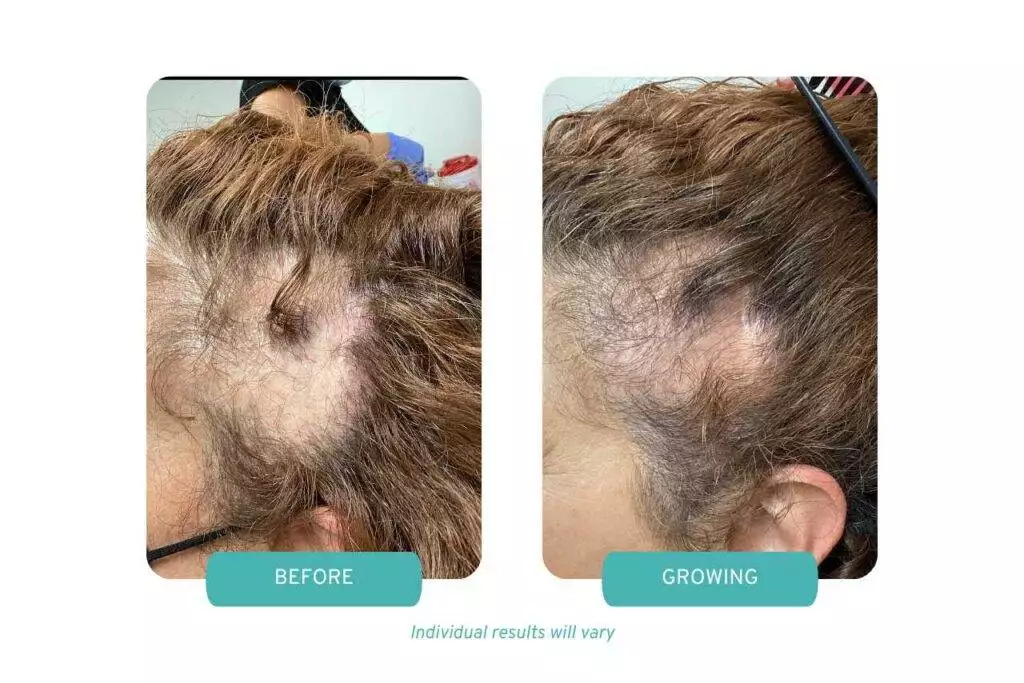 Before and growing comparison of patient in case study 23 with Treating Alopecia Areata With PRP Therapy in Scarsdale, NY.